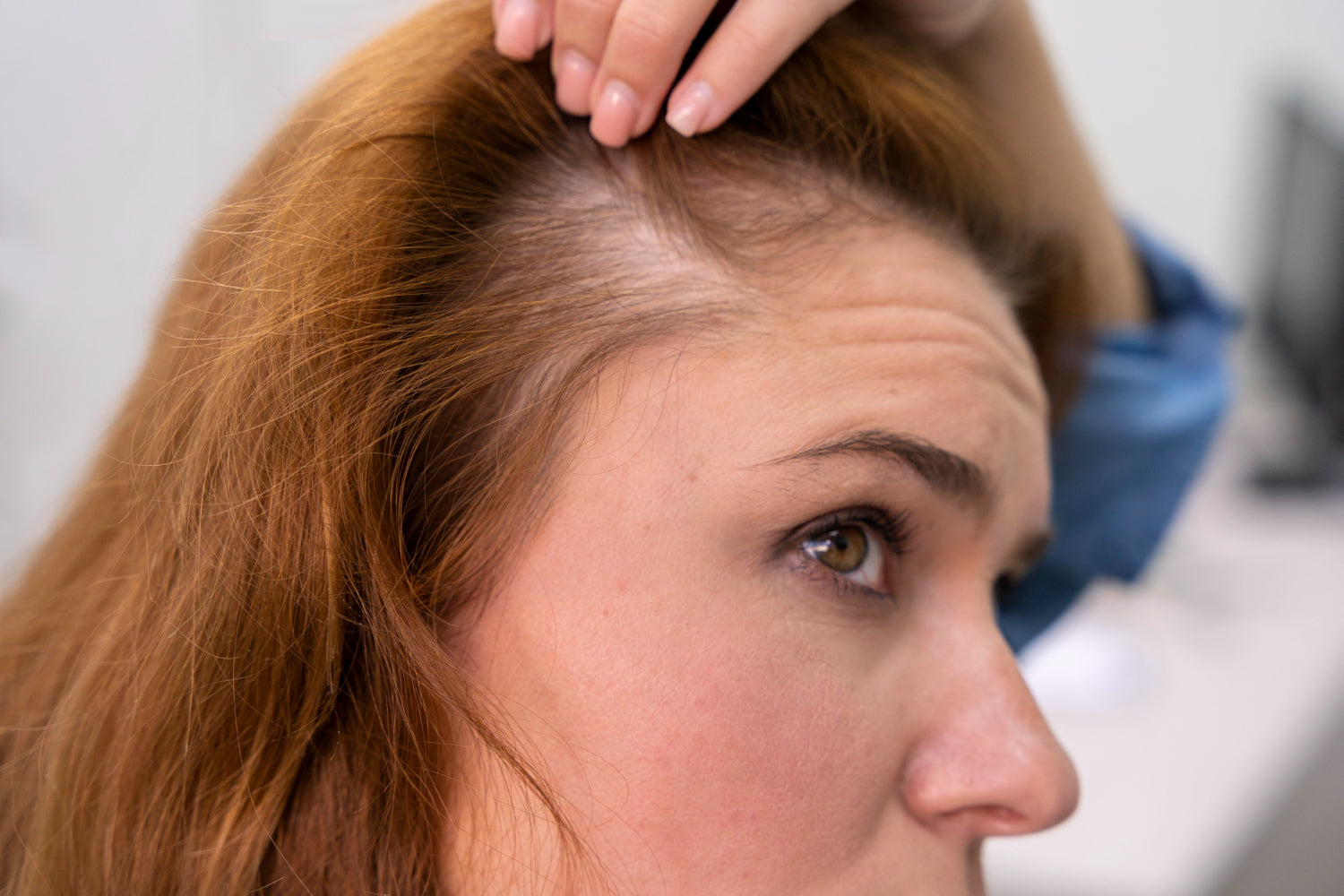 Hair Loss! Can I blame  Genetics?