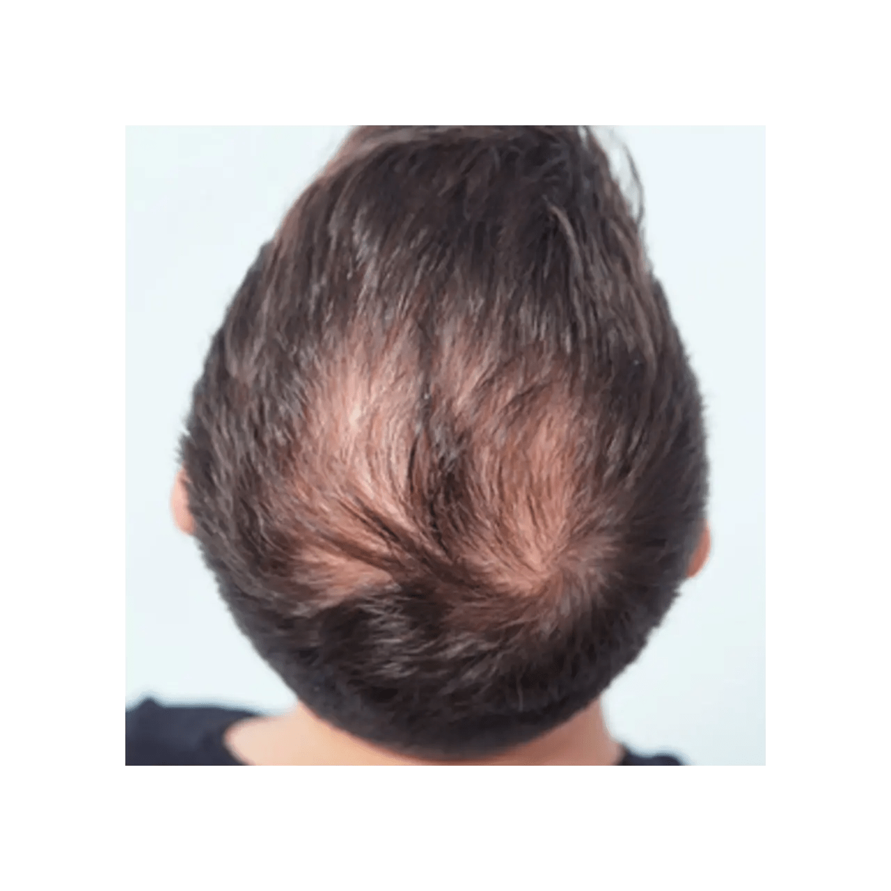 Hair Thinning - It happened to me! - Julian Jay Hair Care