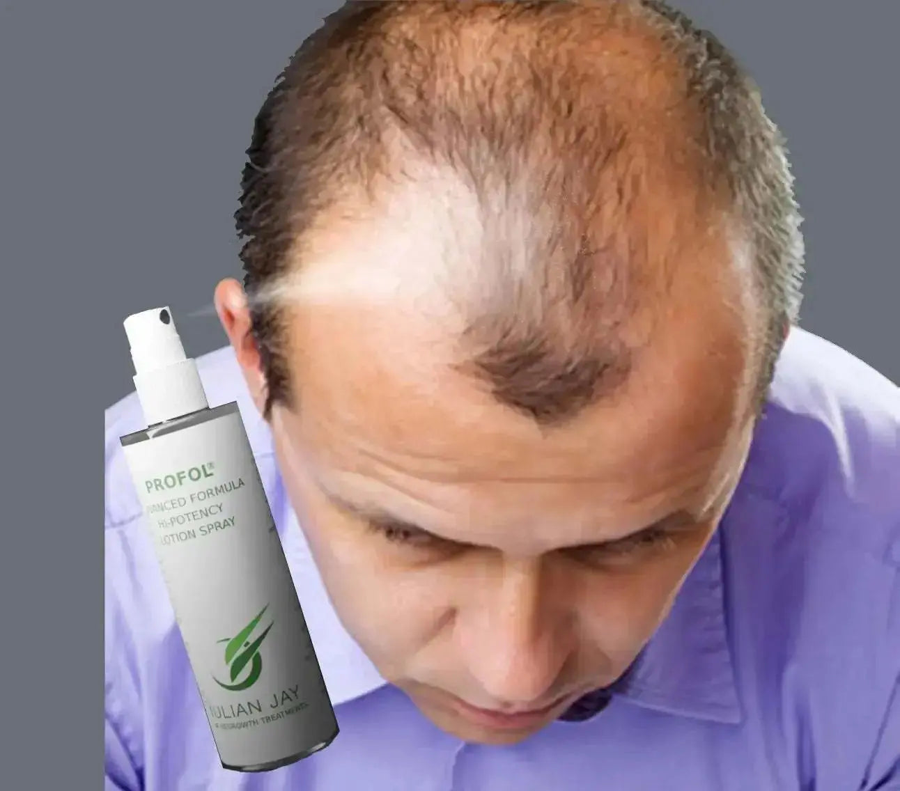 Julian Jay Profol Advanced Formula vs. Minoxidil Topical: A Comparative Study - Julian Jay Hair Care