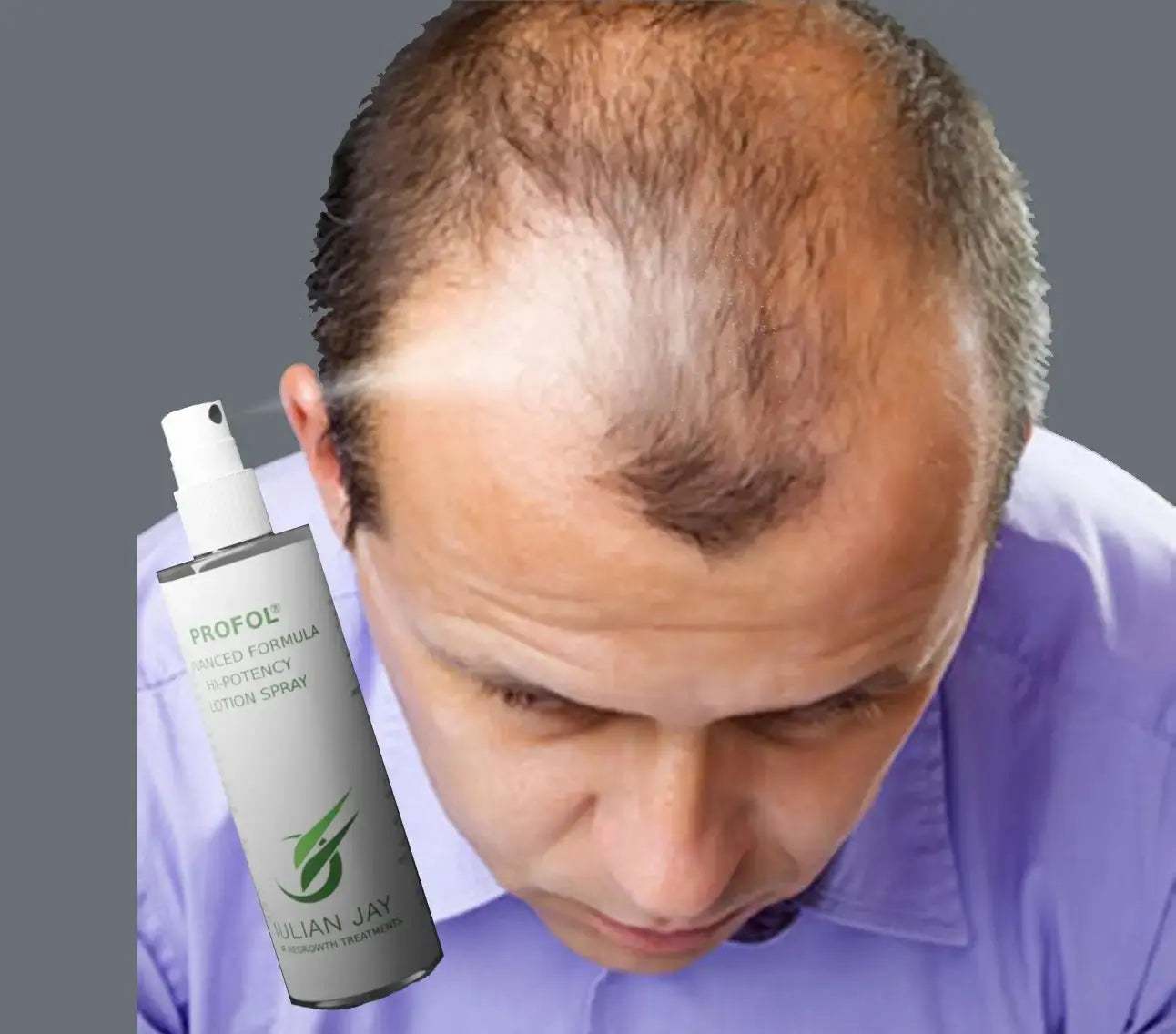 Julian Jay Profol Advanced Formula vs. Minoxidil Topical: A Comparative Study - Julian Jay Hair Care