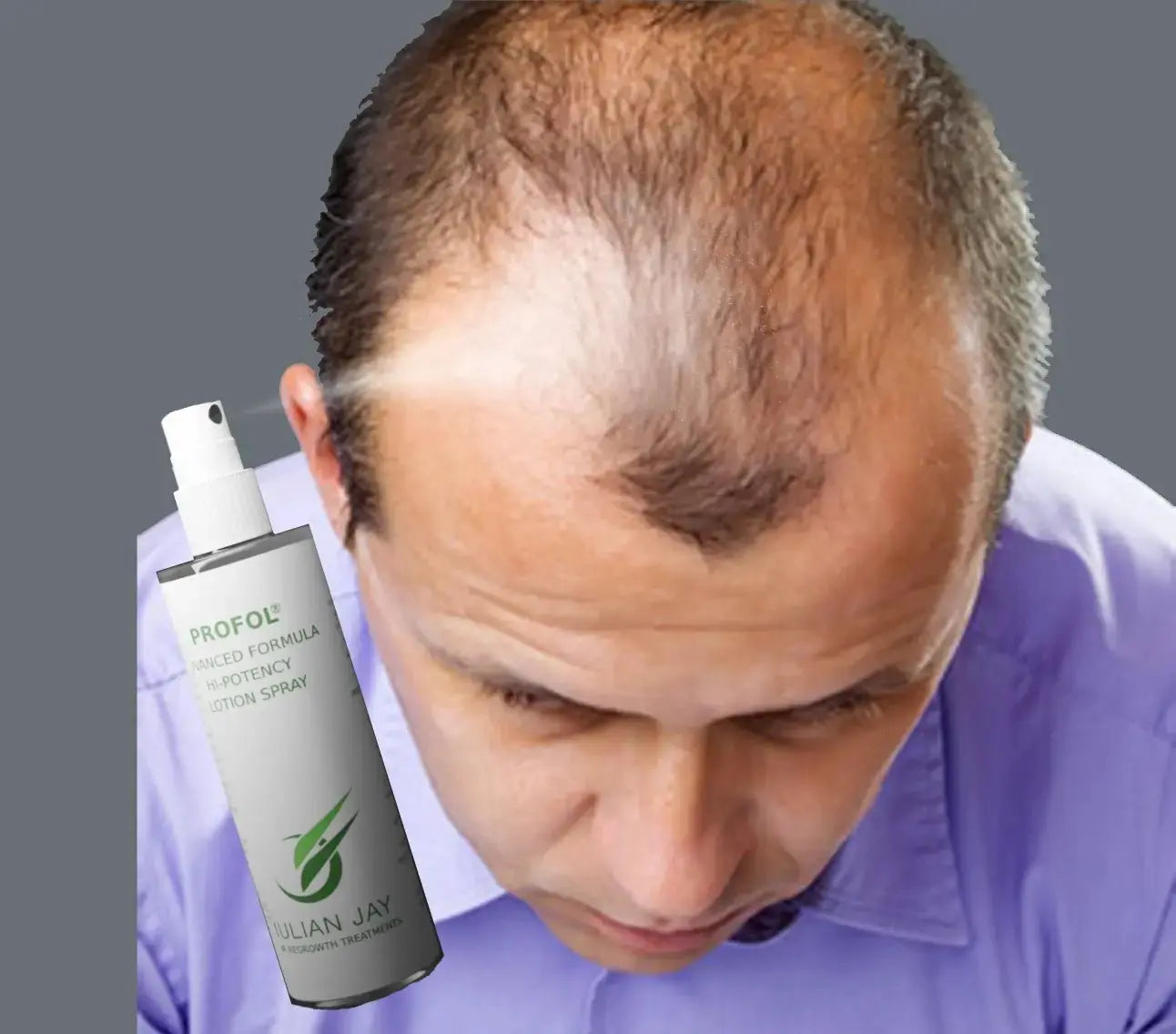 Julian Jay Profol Advanced Formula vs. Minoxidil Topical: A Comparative Study - Julian Jay Hair Care