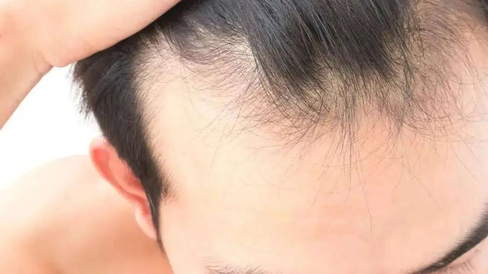 Male hair loss, Address the Imbalance - Julian Jay Hair Care