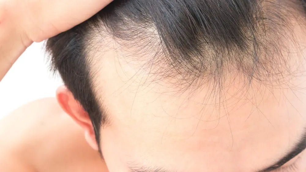 Male hair loss, Address the Imbalance - Julian Jay Hair Care