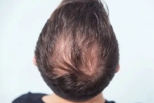 Say Goodbye to Itchy Scalp and Hair Loss: Effective Remedies and Prevention Tips - Julian Jay Hair Care