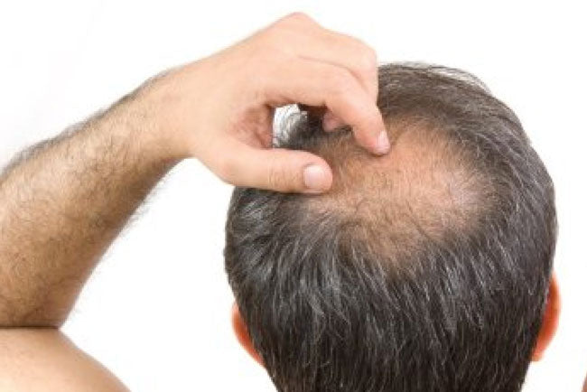 Guidelines for Scalp Irritation Problems with Hair Loss