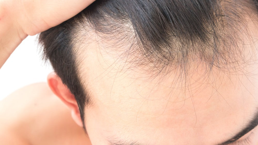 Male hair loss, Address the Imbalance